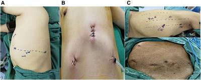 Initial experience with robotic technology for thoracic surgery using the da Vinci Xi system in Tibet, China